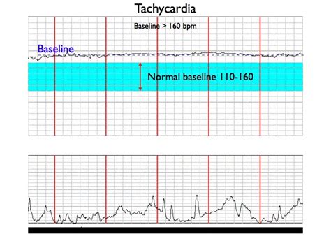 fetal monitoring strips practice|Basic Pattern Recognition – Electronic Fetal Monitoring.